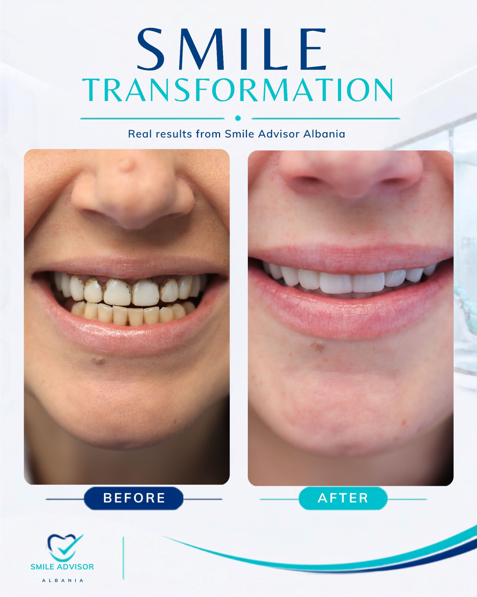 Damaged and stained front teeth before treatment beside a whiter, aligned smile after ceramic restoration