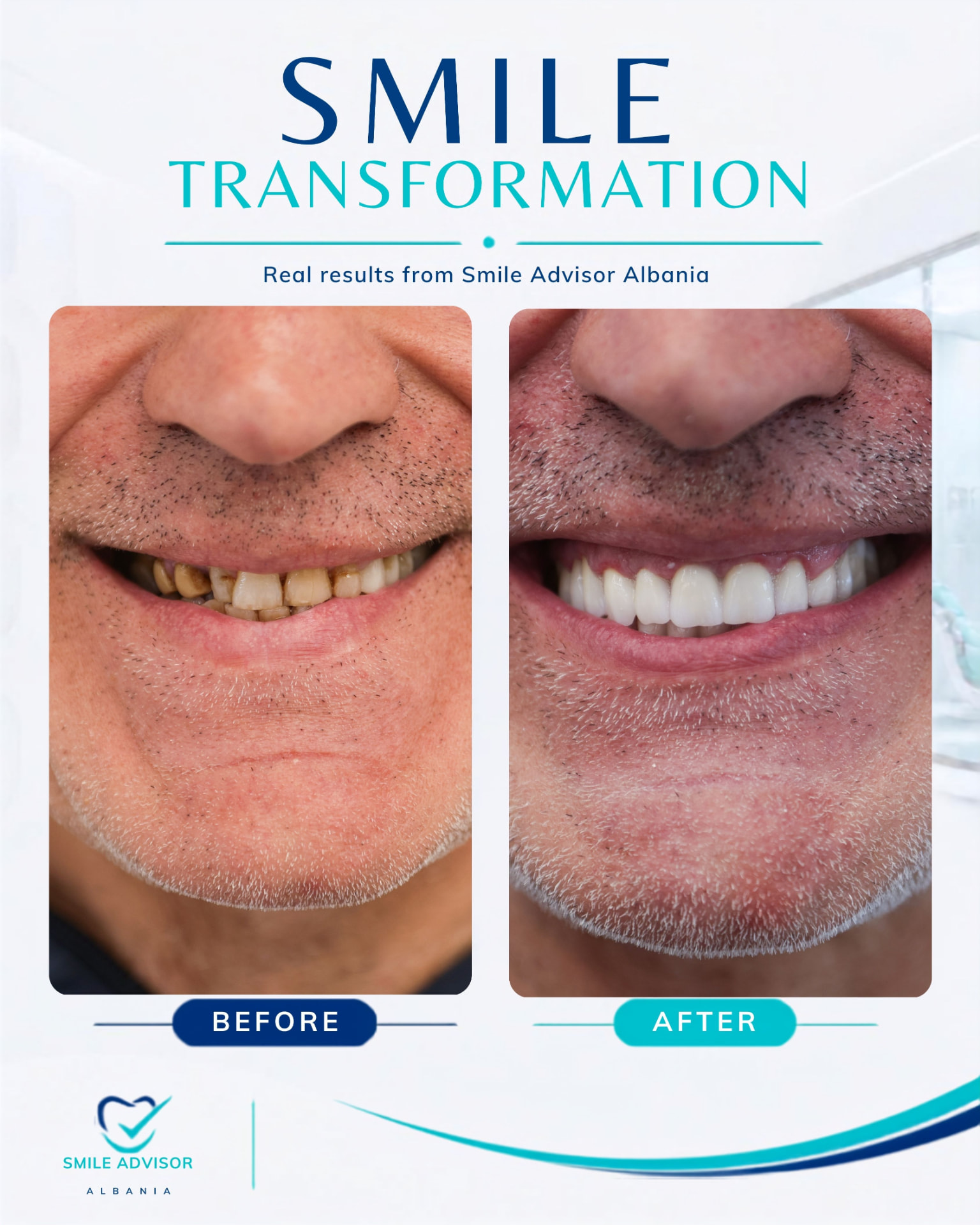 Heavily worn teeth before treatment beside a complete white full-arch restoration after treatment